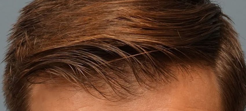 Best Procedures Available-at-Hair Transplant Centers
